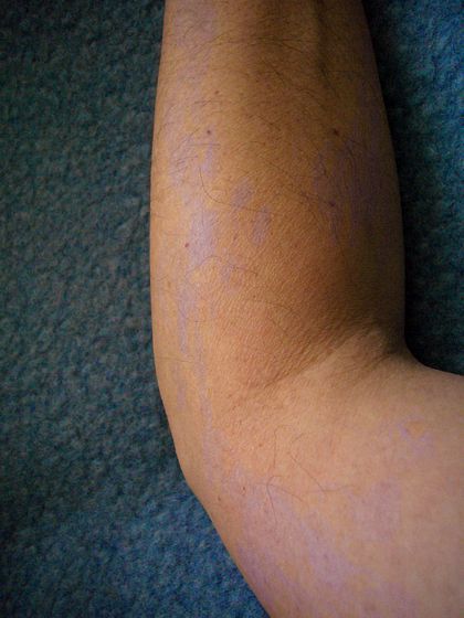 Faint purple bruises on arm; dream image by Wayan.